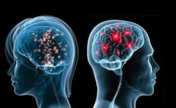 Επιθετική θεραπεία «φρενάρει» τη σοβαρή σκλήρυνση κατά πλάκας